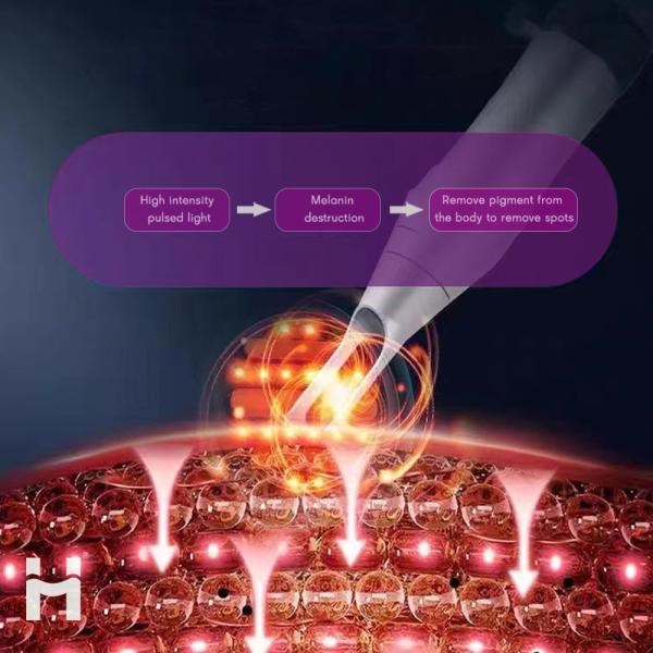 Advanced Pico Laser Technology for Fast and Effective Tattoo Removal at 1064nm 532nm