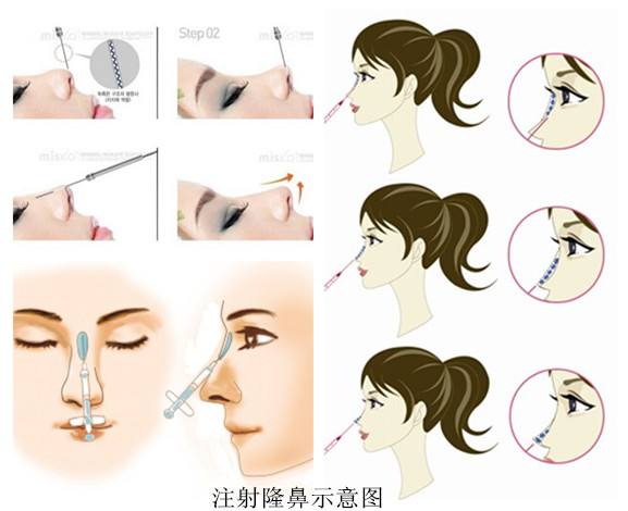 Заполнитель впрыски геля Хялуронате натрия продуктов красоты 1мл дермальный для заботы кожи
