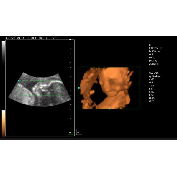 Zoncare 3D/4D Trolley Medical Digital Color Doppler Ultrasound System for Hospital