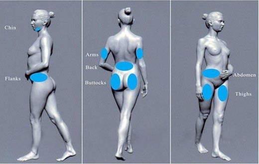 Машина Cryolipolysis потери жира для уменьшения жировых отложений легко и безопасно