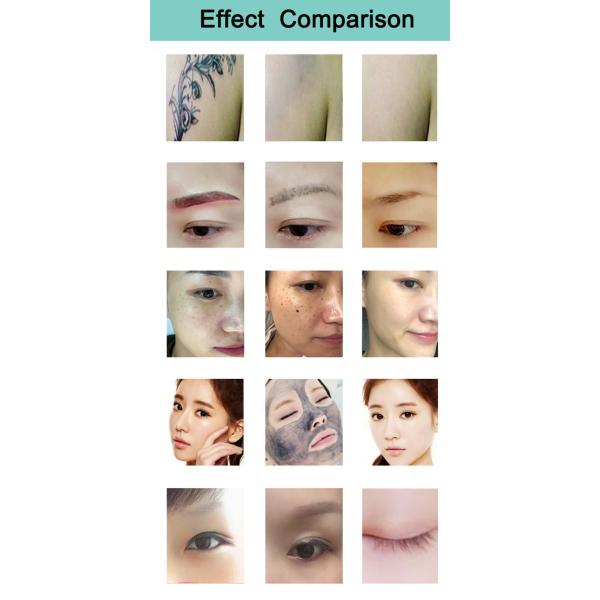 2 в 1 лазере портативном q диода 1064nm 808 переключил удаление татуировки лазера Nd Yag