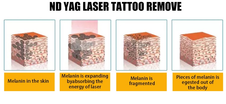Пятна пигмента удаления машины лазера ND Yag удаления пигментацией лазера