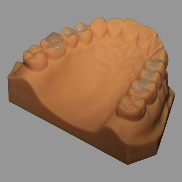 Full Ceramic Dental Emax Inlay Onlay Crown Pressed / Milled