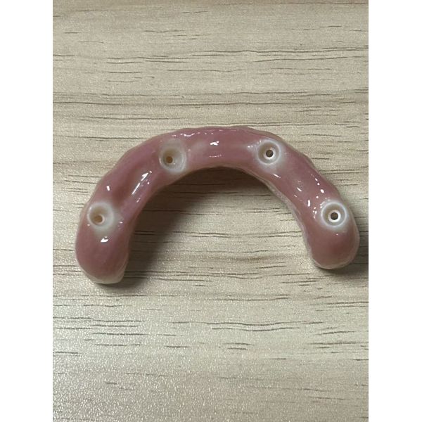 Monolithic Zirconia Implant Bridge for Full Arch Restoration with CAD/CAM Precision