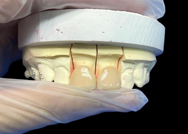 Precision Strength EMAX Porcelain Veneer incisor para restaurações estéticas de aparência natural