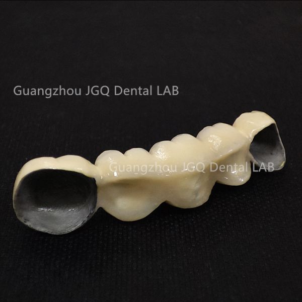Oral Restorations Pfm Teeth 3D Laser Printing Ultra Durable