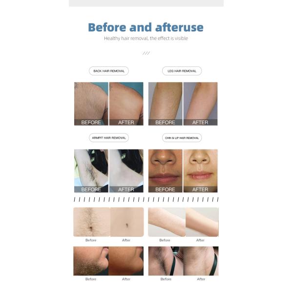 D1-2 808 diode laser hair removal machine professional tattoo removal device laser picosecond carbon peel machine