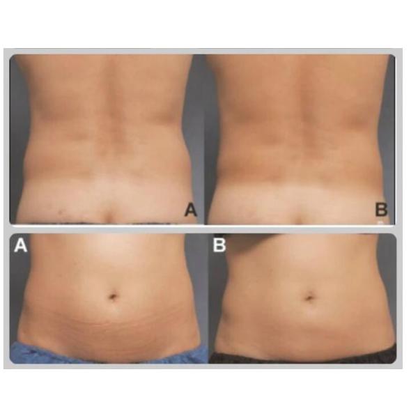 Portable Body Slimming Machine , Diode Lipo Laser Fat Burning Equipment