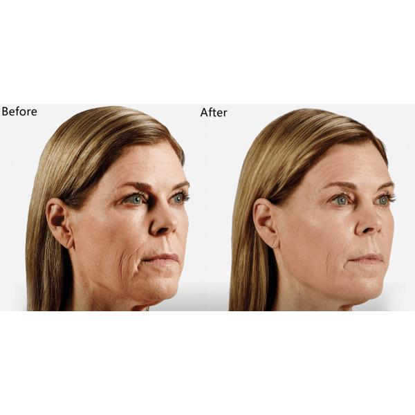 Повышение губы Juvederm 2x1ml заполнителя Ha впрыски извлекает морщинки