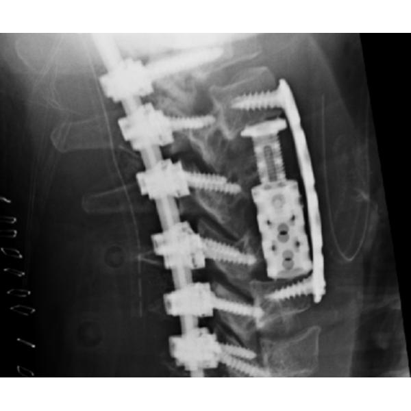 Black / Blue Cornerstone Peek Cage , Expandable Titanium Spinal Cage