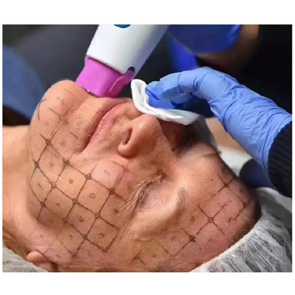 Thermagic RF Radio Frequency Facial lifting Skin Rejuvenation Beauty Machine