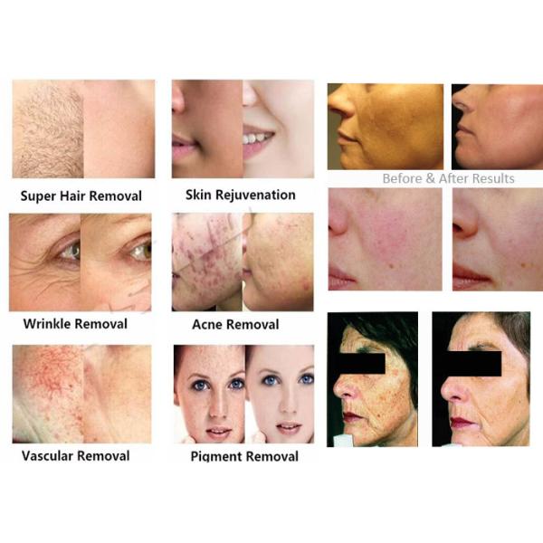 360 Magneto Optic Vasular Removal / Acne Scar Removal Machine Painless