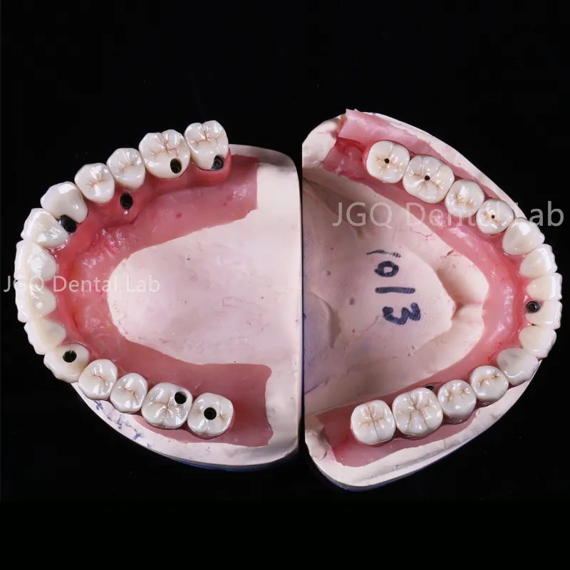 Ball-Cap Implant Overdenture Offers Excellent Stability and Retention Suitable for Elderly Patients Lab Prices