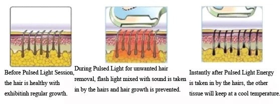 Skin Rejuvenation E-light Laser Machine IPL Intense Pulsed Light Hair Removal Machine