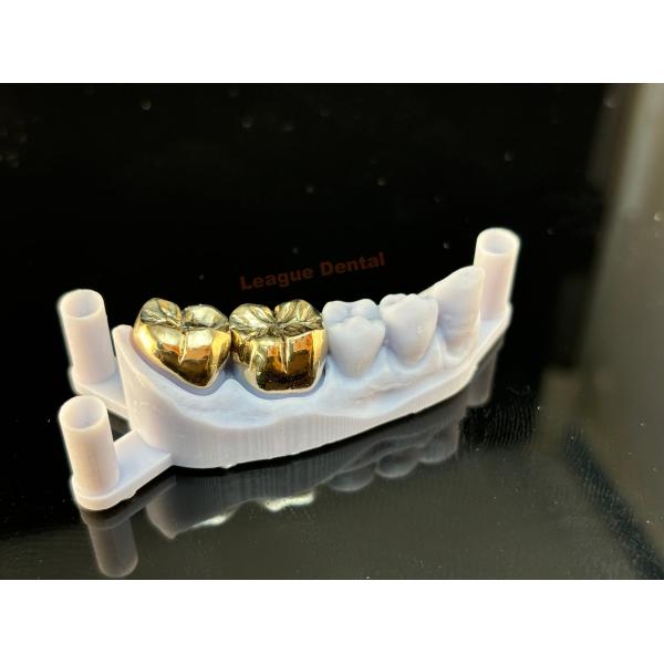 Investing And Casting Full Metal Crown Biocompatibility Metal Crown Tooth