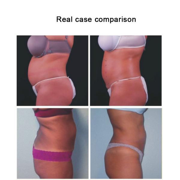 Radio Frequency Skin Tightening Machine , Fast Body Slimming HIFU Ultrasound Equipment