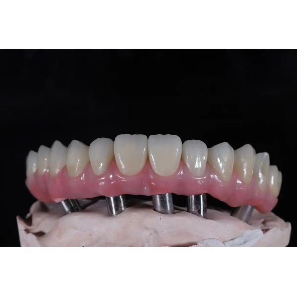 Multi Unit Abutment Titanium Alloy Zirconia Bridge Dental Implant Durable Prosthesis