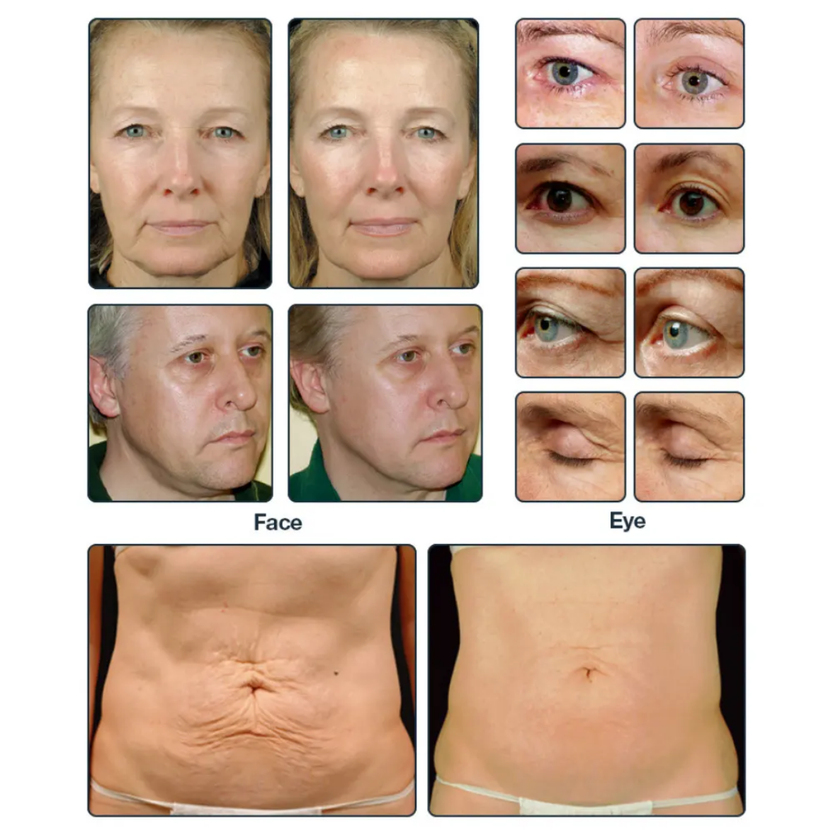 Professional RF Microneedling Machine , 5MHz RF Skin Tightening System