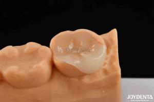 polymerized porcelain Composite Inlay And Onlay Aesthetic And Durable Restoratio