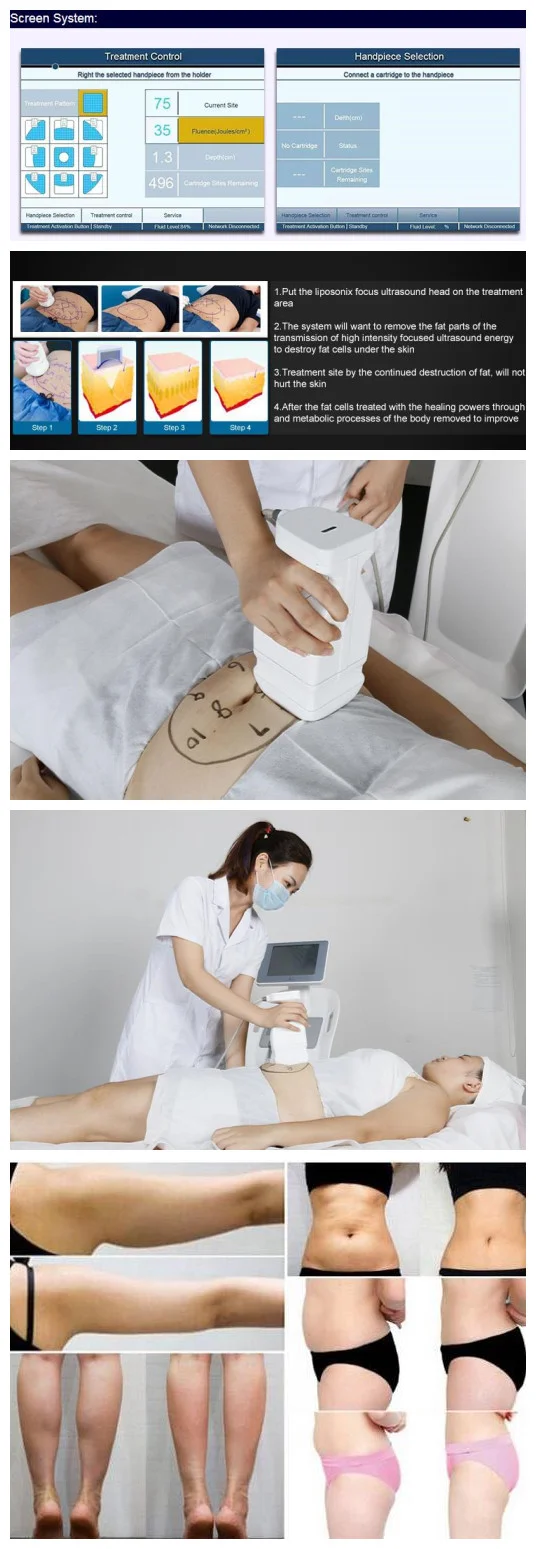 Operation System:Ultrasonic Feature:Anti-Puffiness; Wrinkle Remover; Skin Tightening Model Number:HIFU03 Brand Name:HP P