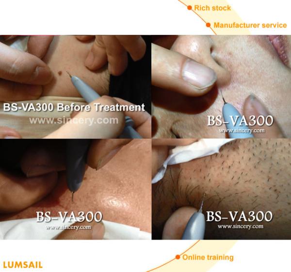 Vein Vascular removal Effective Portable Spider Veins Removal Vascular removal beauty equipment