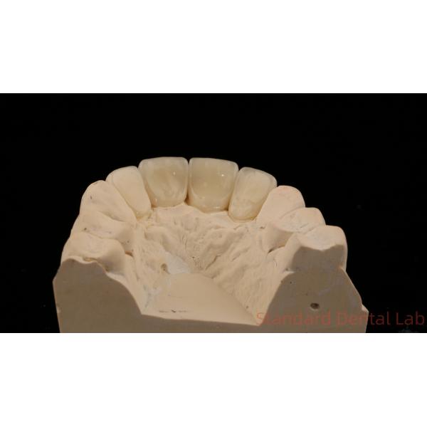 Strong Layered Zirconia Crown And Bridge In Good Esthetics Zirconia Layered China Dental Lab