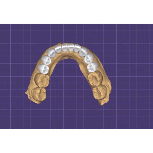 Precision Fit Digital Wax Up Dental Study Model with Durable and Biocompatible 3D Printed Design
