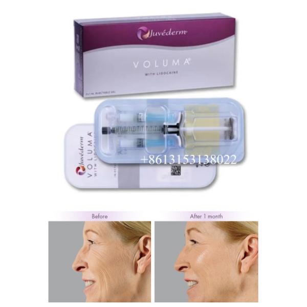 Juvederm Voluma Injectable Dermal Filler HA Gel For Face