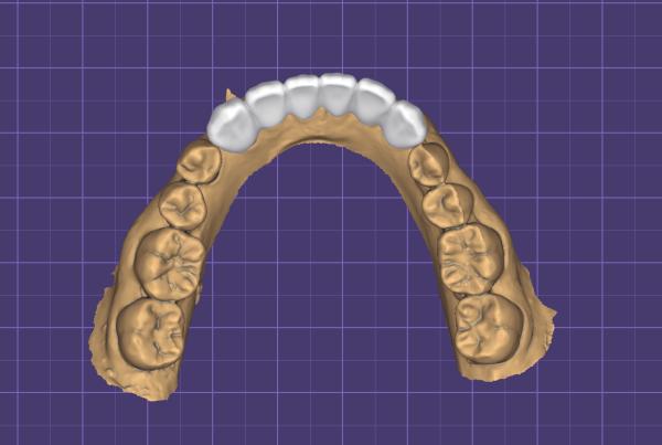 Precision Fit Digital Wax Up Dental Study Model with Durable and Biocompatible 3D Printed Design
