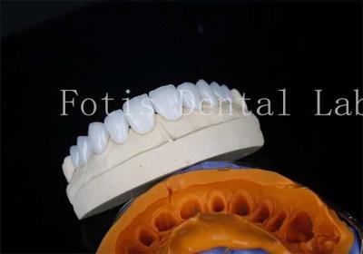 Porcelain Dental Lab Veneers Bonding Cement For Long Lasting Restorations