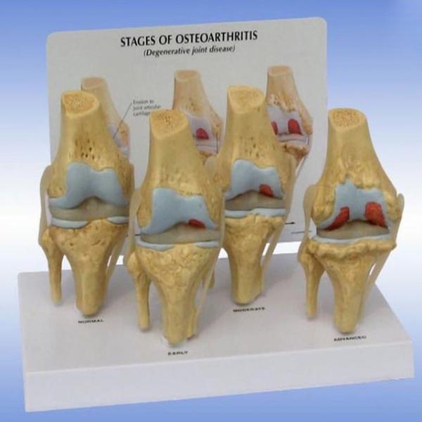 Skeleton Osteoarthritis 7.5x14x6cm Human Knee Model