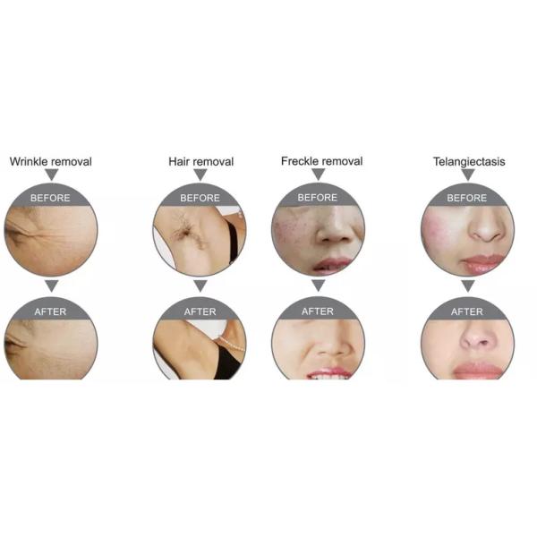 Жара машины лазера IPL OPT ELight RF YAG охлаждая для Multi машины обработок