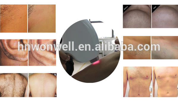 Diode laser 810nm for hair removal and skin rejuvenation whitening