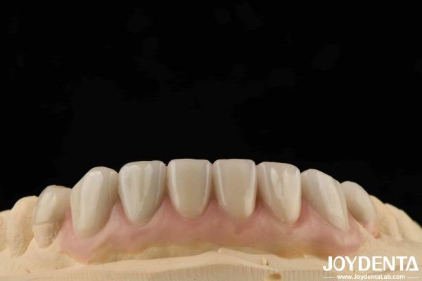 High Translucency Emax Cosmetic Dentistry Veneers High Aesthetics Ultra Thin