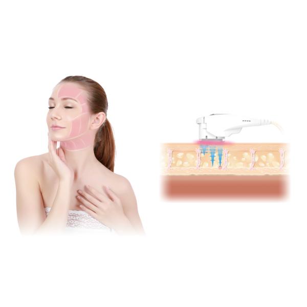 Nasolabial Fold removal High Intensity Focused Ultrasound 50Hz / 60Hz