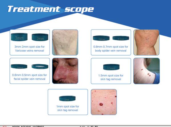 2017 latest 980nm diode laser spider vein/ skin tag removal machine
