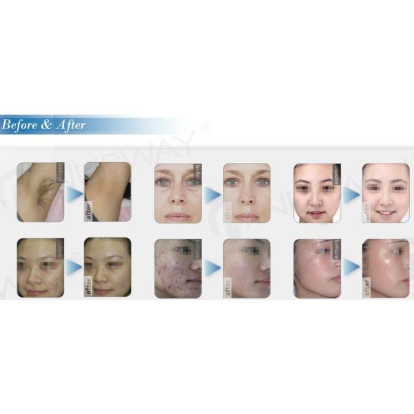 Wholesale Price Portable Diode Laser Hair Removal Machine with Permanent & Painless light
