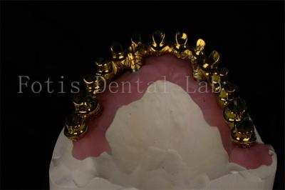 Natural Looking All On 4 All On 6 Dental Implants Restores Full Chewing Ability