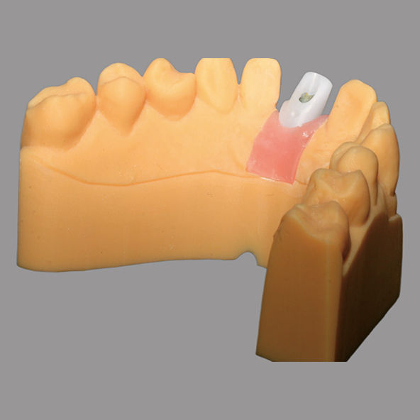 White Custom Zirconia Abutment Natural Looking For Dental Restoration