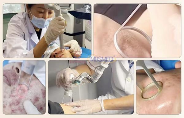 Vaginal Tightening Q Switched Nd Yag Carbon Fractional Co2 Laser Vaginal Tightening Machine