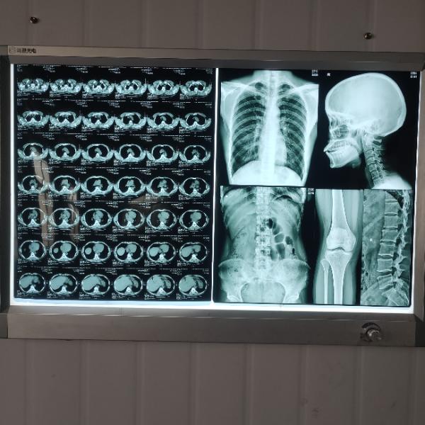 chorro de tinta X Ray Film de la pulgada de 8x10 10x14 14x17 210 micrones