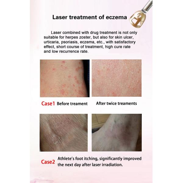 spider veins vascular vein removal nail fungus 980nm diode laser therapy machine for toe nail fungus treatment
