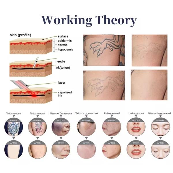 Professional Q switched Nd Yag Medical 1064nm 532nm Laser Tattoo Removal Machine