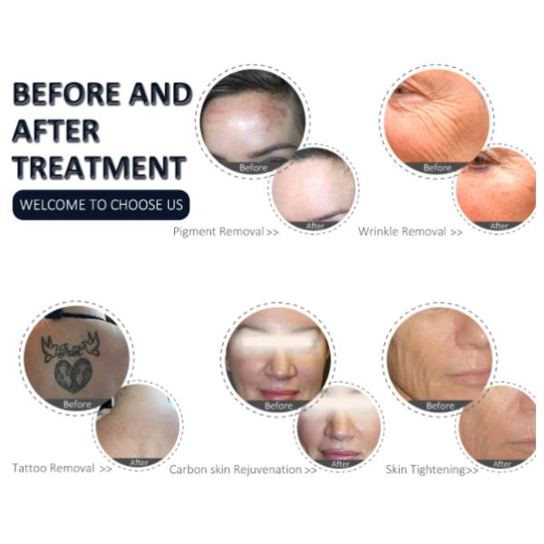 RF Elight Laser Hair Removal 2 Handpiece 640nm 560nm Skin Rejuvenation Machine