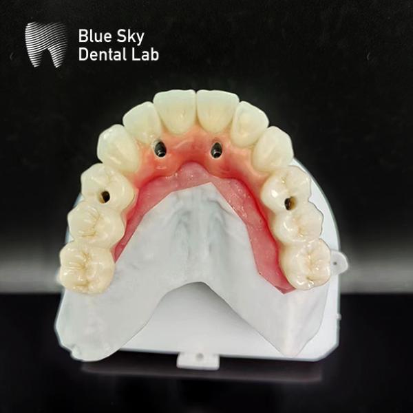 Cas d'implant de la bouche entière personnalisé Compatibilité universelle