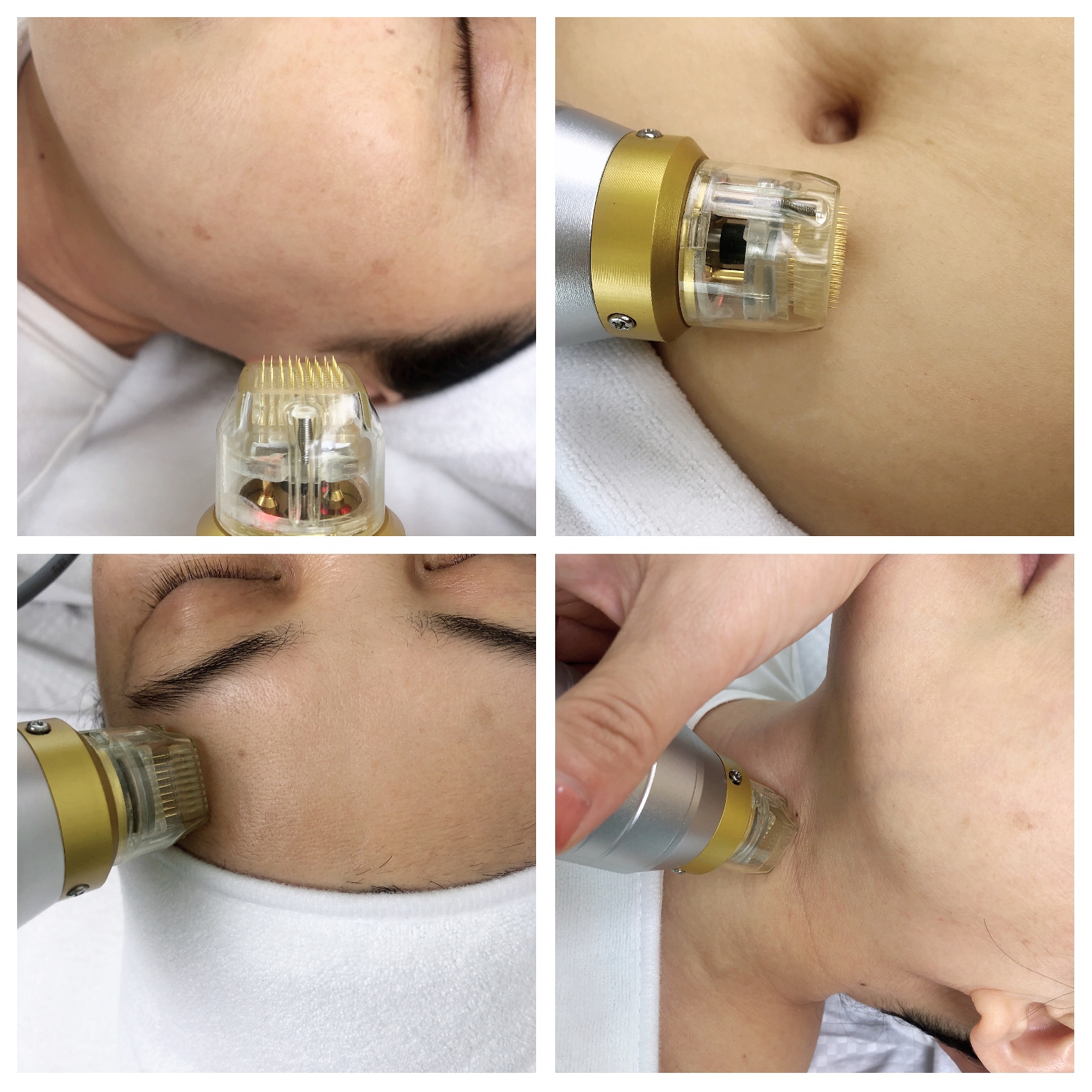 Степень Microneedling Frational RF удаления 45 меток Strectch
