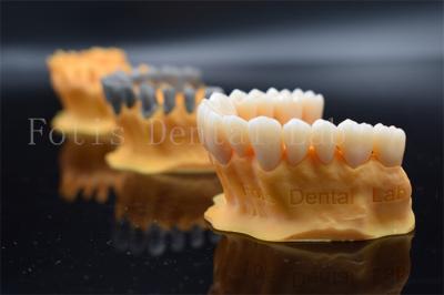Quick Full Ziconia Design Digital Crowns 3 Shape / Exo Design Same Day Manufacturing