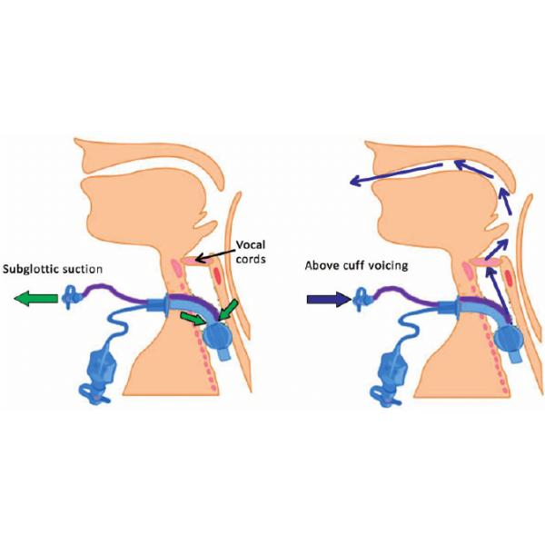 Безопасность Медицинская одноразовая трахеостомическая трубка высокого объема с субглотальной всасывающей трубкой