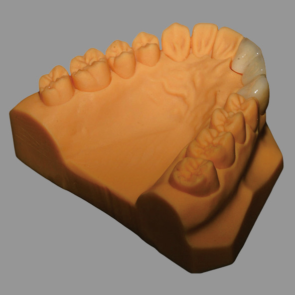 Puente PFZ de cerámica completa biocompatible con sistema CAD/CAM