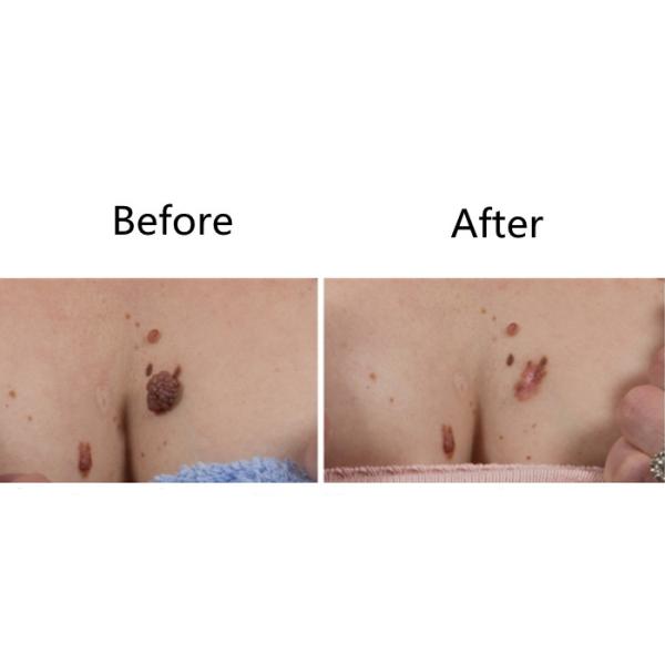 Máquina fraccionaria 10600nm del laser de Vaginal Tightening Co 2 inmóviles